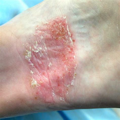 Dyshidrotic eczema on the feet - MOST® Skincare