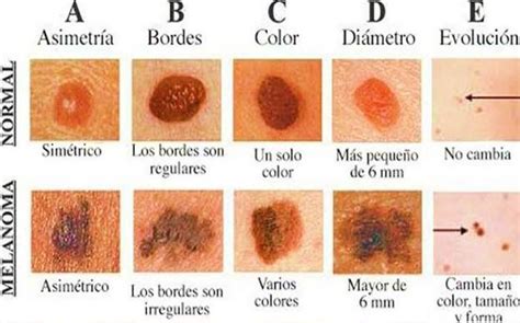 Ananiver ciclo Venta ambulante señales de melanoma comienzo análisis ...