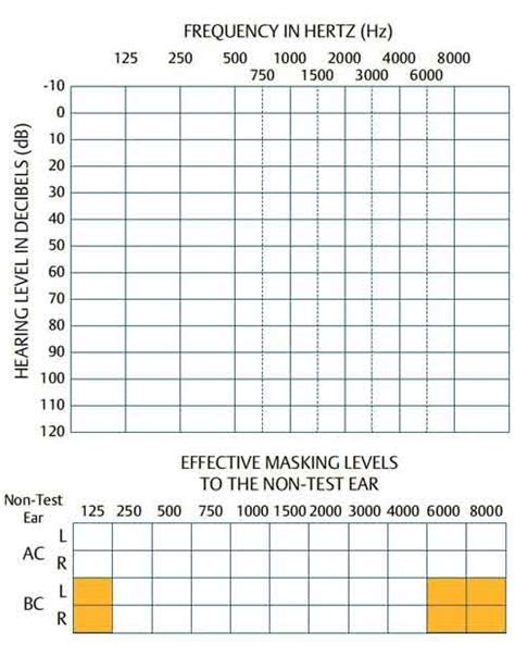 Pure Tone Audiogram: Symbols | Configuration | Interpretation