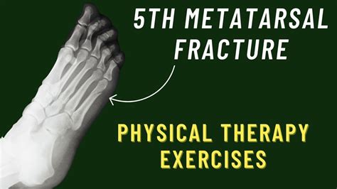 5th Metatarsal Fracture Exercises | Jones Fracture Rehab Exercises ...