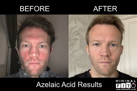 How I Cured Rosacea Using Azelaic Acid (Before & After Pics) | Minimal FIT