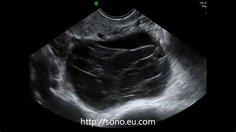 Hemorrhagic Ovarian Cyst on Transvaginal Ultrasound - YouTube