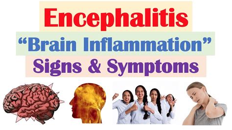 Encephalitis (“Brain Inflammation”) Signs and Symptoms (& Why They ...