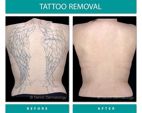 Tattoo Removal Before And After