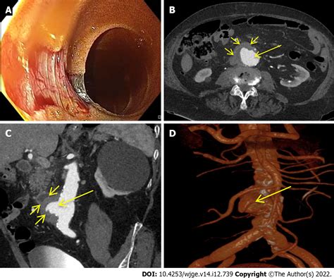 Role of multidetector computed tomography angiography in non-variceal ...