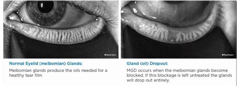 Meibomian Gland Dysfunction | Silicon Valley Eye Physicians ...