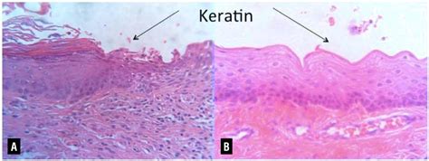 Stratified Squamous Epithelium Keratinized Vs Non Keratinized