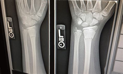 What is the Difference Between a Fracture and Sprain?