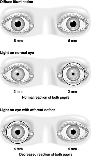 AccessLange: General Ophthalmology ; Chapter 14: Neuro-ophthalmology ...