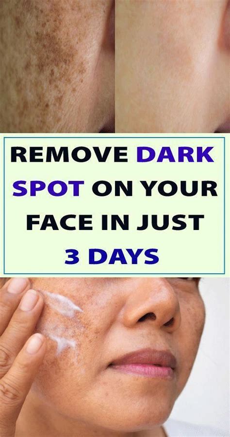 How To Remove Blackheads Marks From Face - Aurelavana