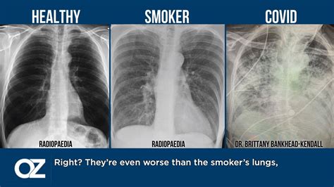 Dr. Mehmet Oz - The Difference in Lung Scans: Healthy vs. Smoker vs ...