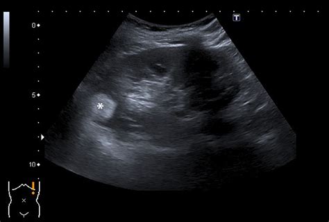 Kidney Ultrasound Tumor