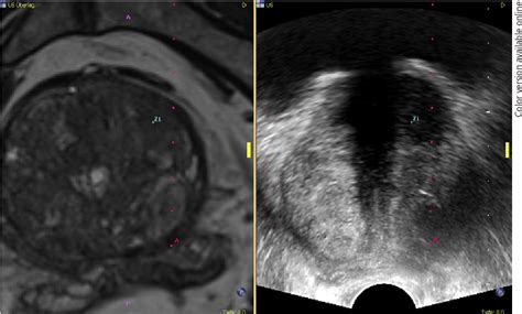 Figure 2 from Multiparametric MRI Lesion Classified as Prostate Imaging ...