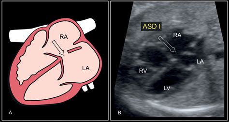 Ventricular Septal Defect Ultrasound