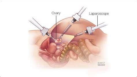 Living With Cancer: Ovary removal surgery - Mayo Clinic News Network