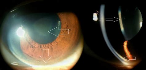 Wilson's Disease/Kayser Fleischer Ring - EyeWiki