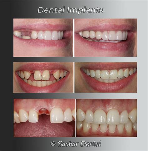 Dental Implant NYC at Sachar Dental