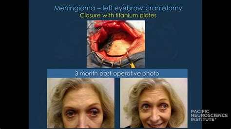 Meningioma: Minimally Invasive Keyhole & Endoscopic Surgery - YouTube