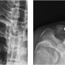 Clavicle fracture 2 years prior to this illness. | Download Scientific ...