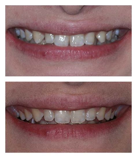 Clear Braces - Before & After | Bartholomew Dentist