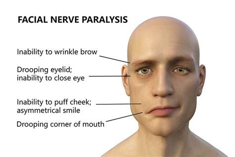 Facial Palsy: Causes, Symptoms, Diagnosis & Treatment - Public Health Notes