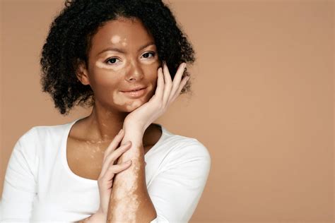 Vitiligo Explained: From Causes to Comprehensive Treatment Options