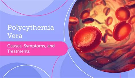 Polycythemia Vera: Causes, Symptoms, and Treatments | myMPNteam