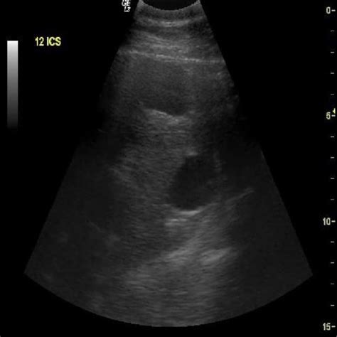 Radiograph showing multiple hydatid cysts in lungs. Fig 2 ...