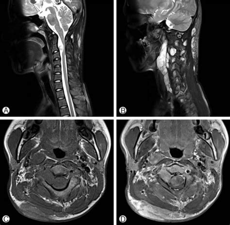 Preoperative MRI of cervical spine: T1 (A) and T2-weighted (B) sagittal ...