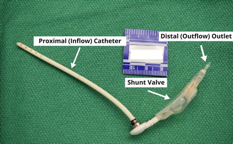 Example of a VP shunt from an autopsy unrelated to our cases. The ...