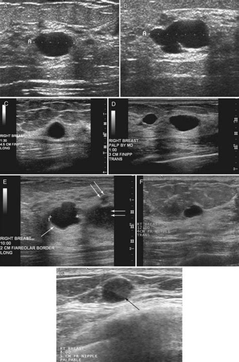 Breast Ultrasound Radiology Key