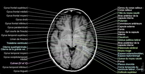 Cerveau - IRM en coupes axiales : anatomie normale | e-Anatomy