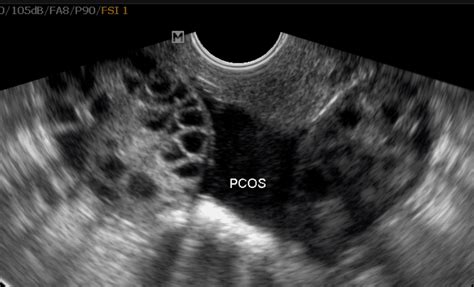 POCS ultrasound