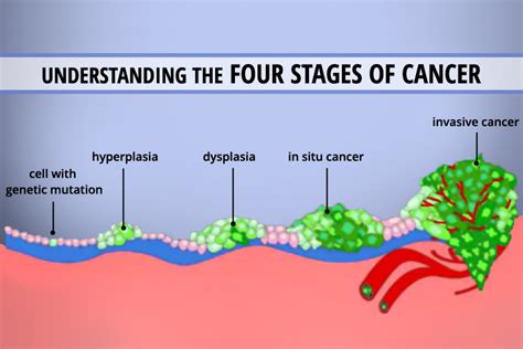 Understanding The 4 Stages Of Cancer - CancerWalls