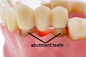 Dental bridge design. General concepts