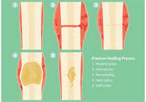 Fractures and Healing Process Vectors - Download Free Vector Art, Stock ...