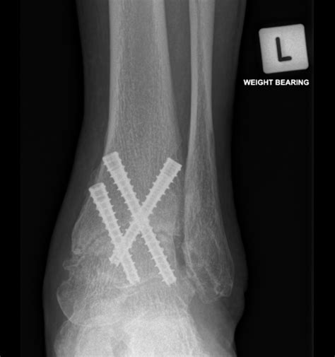 Ankle Fusion - Arthritis | Dr Mike Smith | Orthopaedic Ankle Surgeon