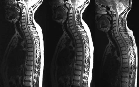 Early MRI scans could predict multiple sclerosis disability | UCL News ...