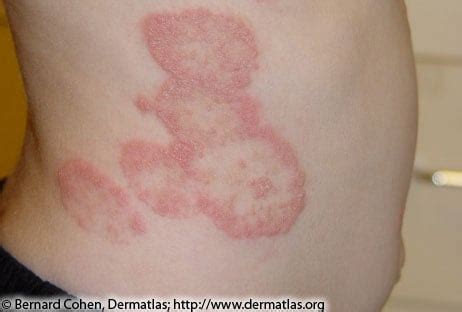 Lyme Disease Rashes and Look-alikes | Lyme Disease | CDC