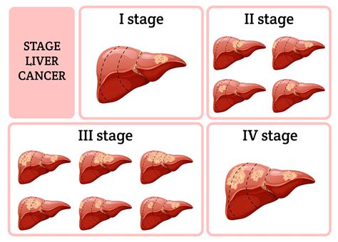 Liver Cirrhosis Stages