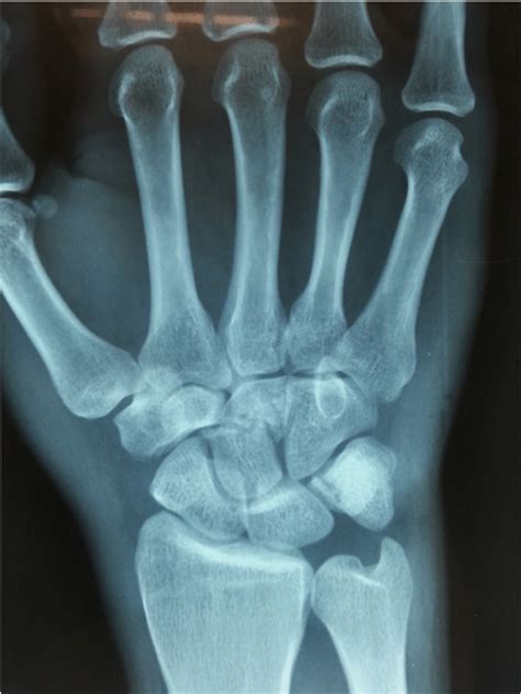 An AP view radiograph of the right wrist showing collapsed capitate ...