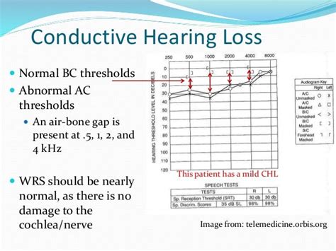 Audiogram interpretation