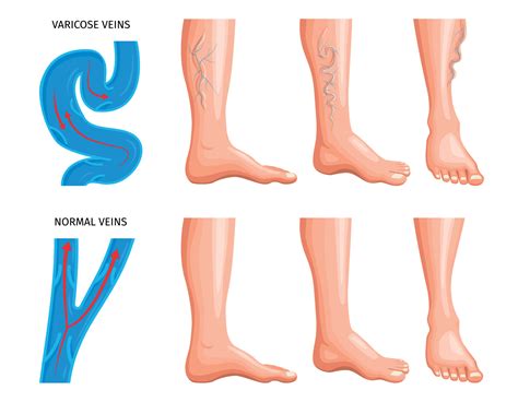 Varicose Veins Anatomy Realistic Set 12680348 Vector Art at Vecteezy