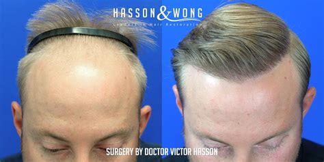 Hair Transplant Before After | Some Of Our Favorite Results From 2019!