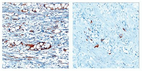 Goblet Cell Carcinoid/Mixed Adenocarcinoma-Carcinoid | Basicmedical Key