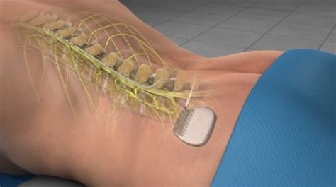 Spinal Cord Stimulator Trial (for CRPS) - Cahaba Pain and Spine Care