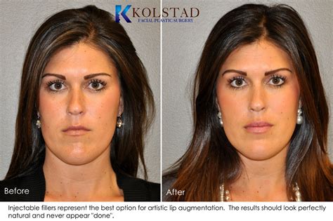 Lip Augmentation Before & After Gallery | Dr. Kolstad - San Diego ...