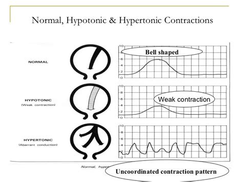 Wiki.assessment of uterine contractions 2011