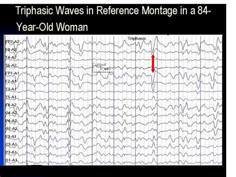 Abnormal EEG patterns