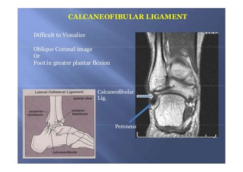 Foot anatomy mri coronal Images